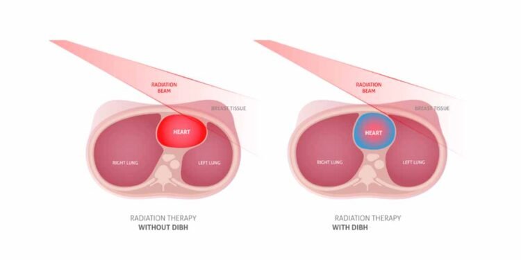 Deep Inspiratory Breath Hold (DIBH) is a game changing modern technique in Breast Cancer Radiotherapy