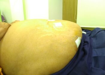 HCG Manavata Cancer Centre performs rare Robotic Surgery on Morbid Obese patient