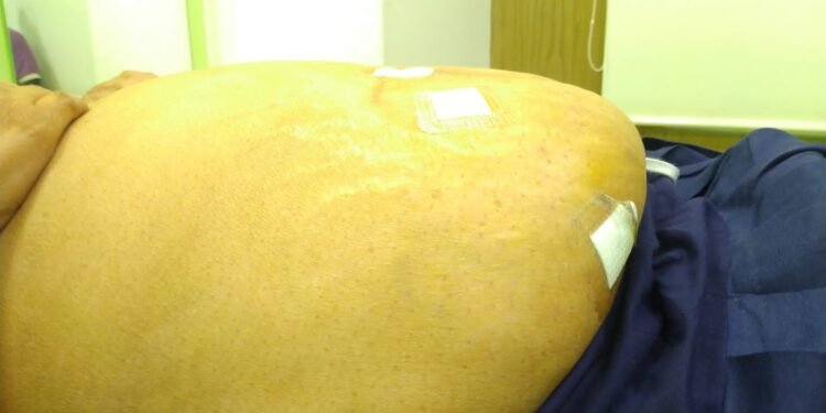 HCG Manavata Cancer Centre performs rare Robotic Surgery on Morbid Obese patient